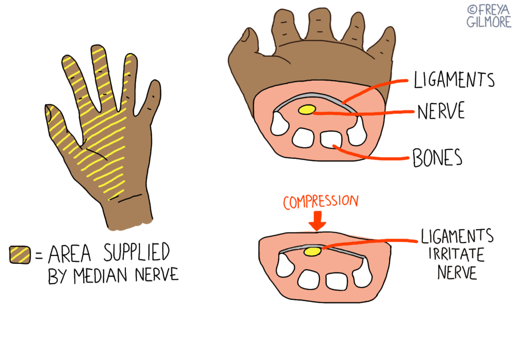 Carpal tunnel syndrome is not uncommon in pregnancy