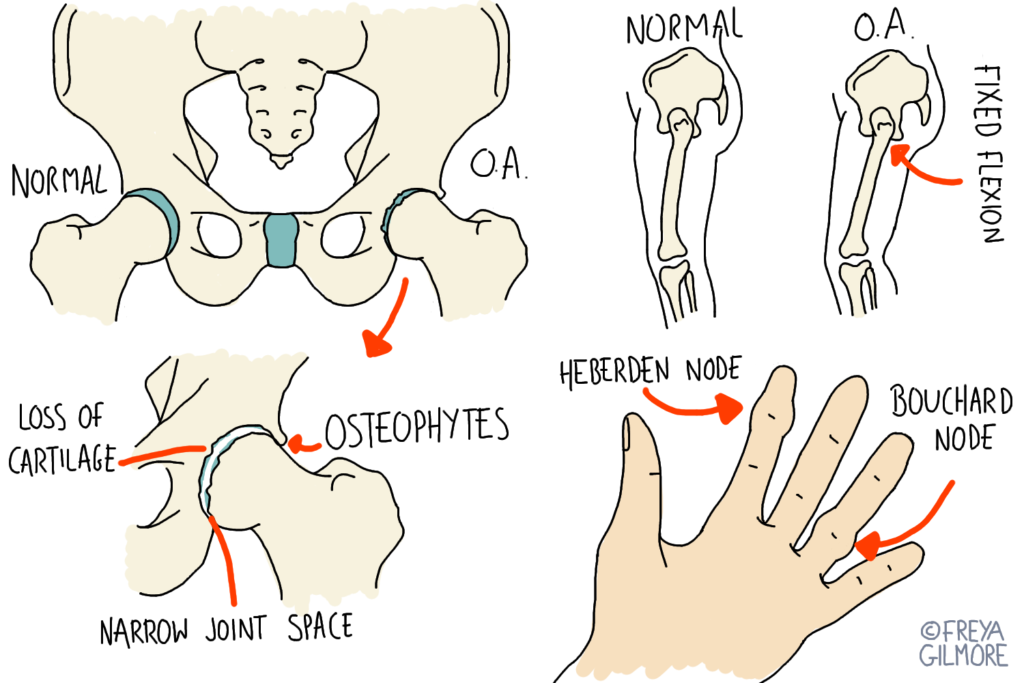 Common symptoms and effects of arthritis