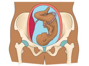 SPD and PGP: Pelvis Pain in Pregnancy