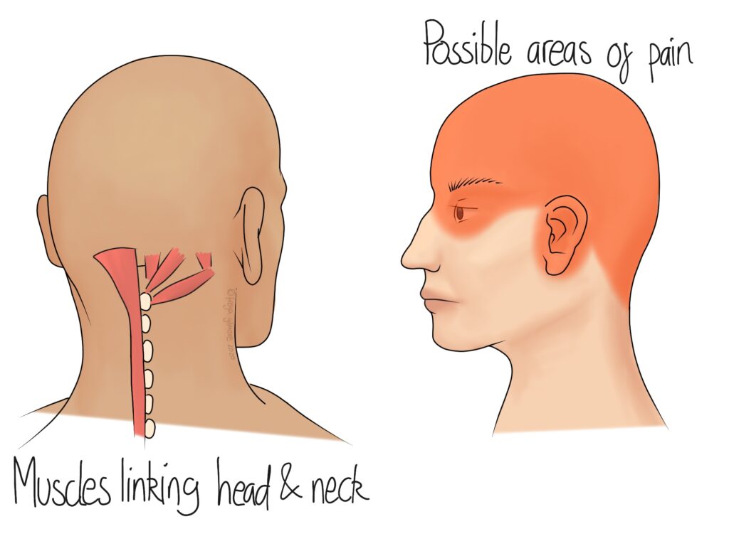 Treating Neck Pain Spreading To The Back of Your Head