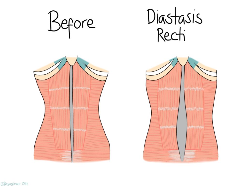 Diastasis Recti - Beth Forrest Osteopathy