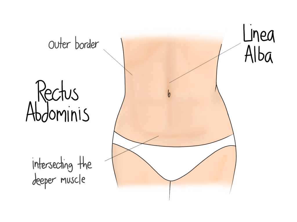 Diastasis Surface Anatomy