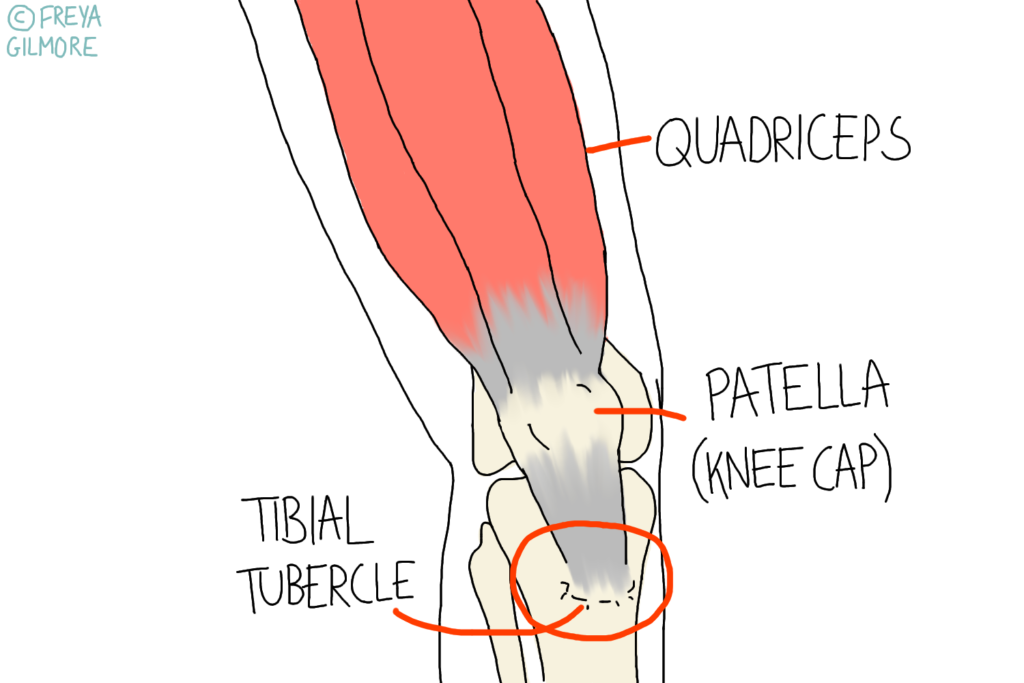 Osgood Schlatter Disease