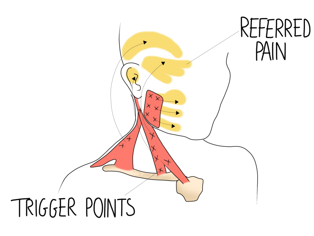 Trigger points in the head and neck