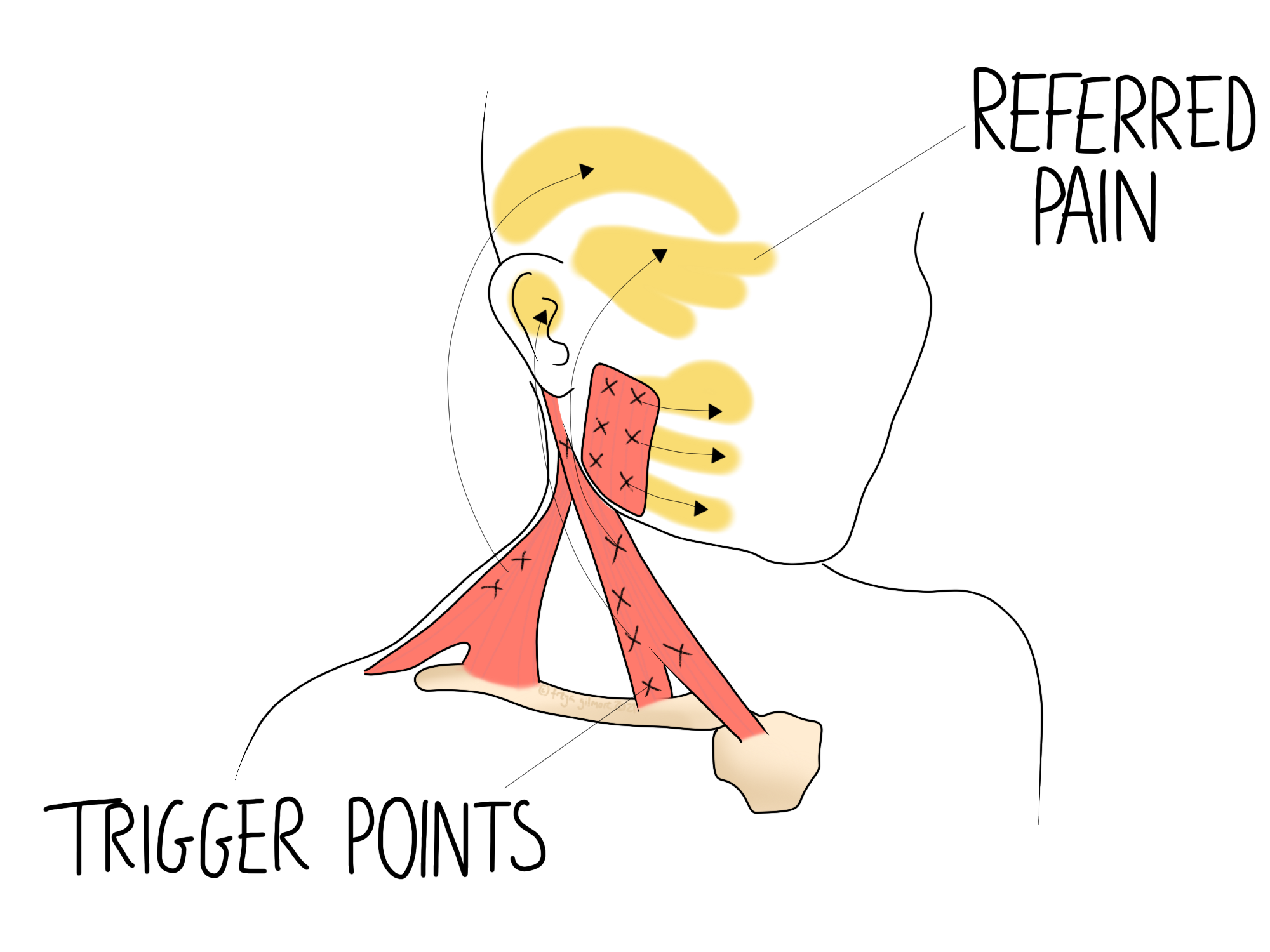 Read more about the article Trigger Points