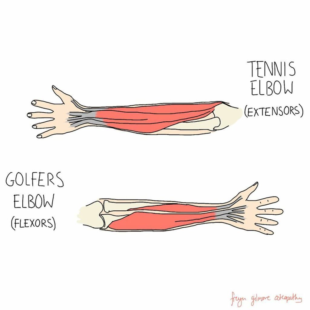 Tennis elbow & golfers elbow