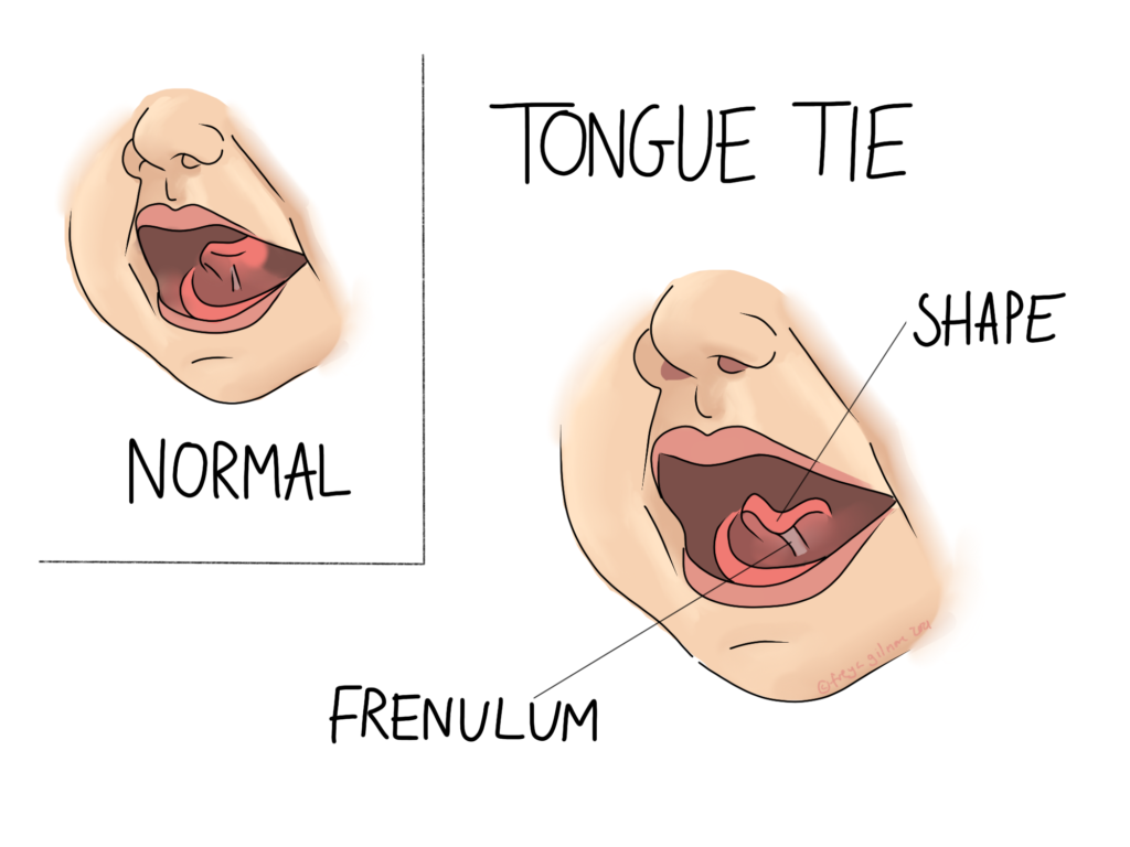 Tongue tie and store breastfeeding