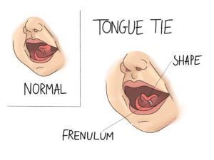 Tongue Tie