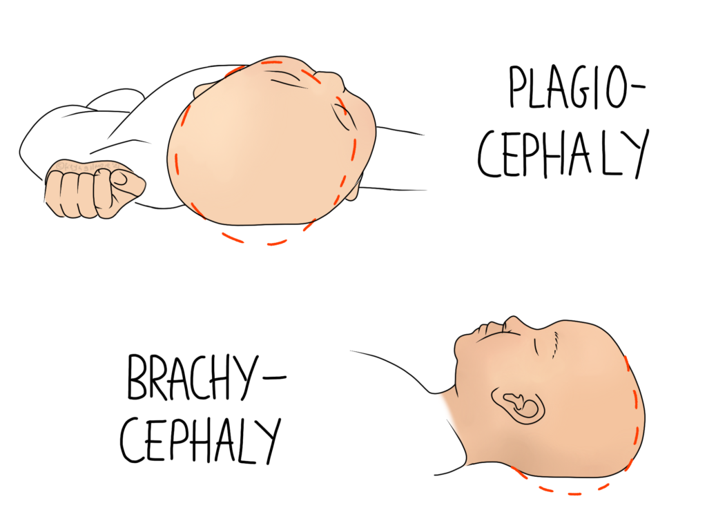 Plagiocephaly and Brachycephaly